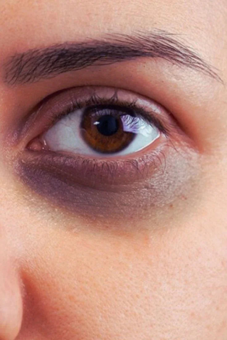 Dark Circles